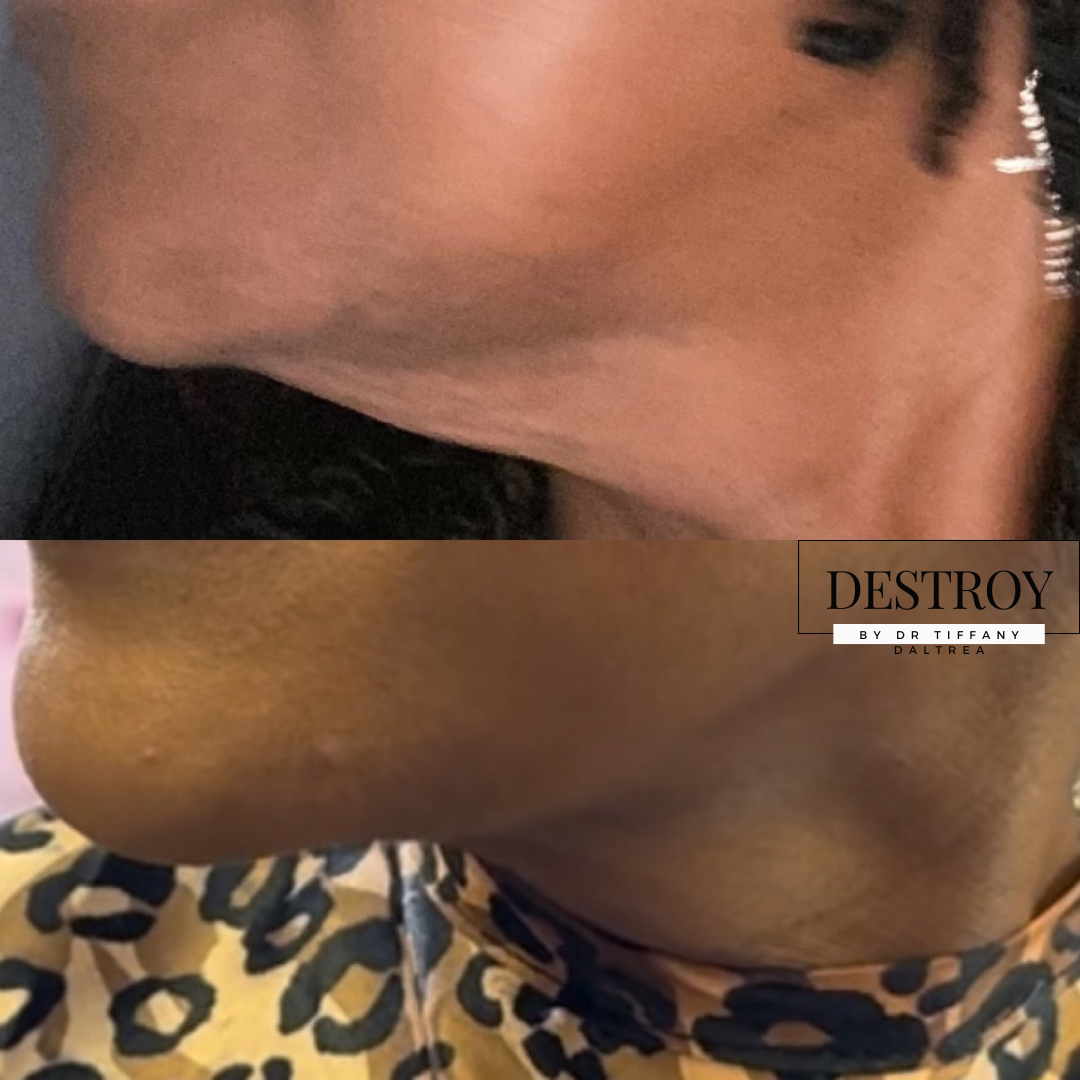 DESTROY™️ Fat Dissolve & Skin Tightening Lotion